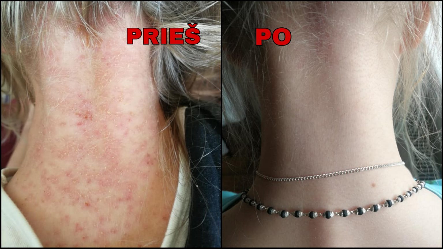 Kaip 6 metų mergaitė atsikratė dermatito pakeitus dietą